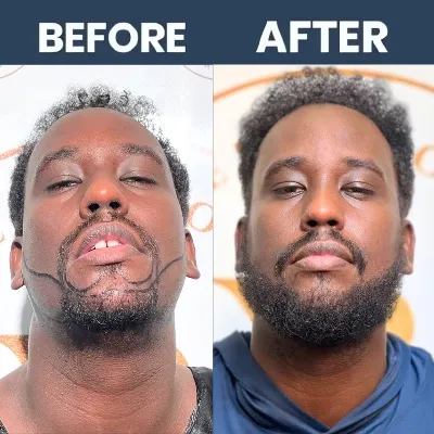 Beard Hair Transplant_Result 06 - Arpil 2025